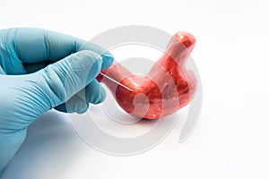 Concept of stomach puncture or gastrointestinal perforation. Hand of surgeon pierces wall of model of human stomach for therapeut