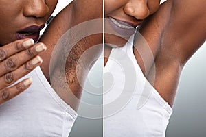 Before And After Concept Of Underarm Hair Removal