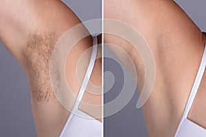 Before And After Concept Of Underarm Hair Removal photo