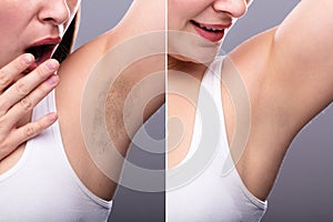 Before And After Concept Of Underarm Hair Removal photo
