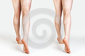 The concept of varicose veins and cosmetic treatment. A caucasian woman massages her legs with and without vascular stars.Rear photo