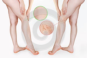 The concept of varicose veins and cosmetic treatment. A caucasian woman massages her legs with vascular stars. Zoom image of blood