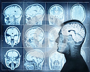 Conceptual image of a man from side profile showing brain activ