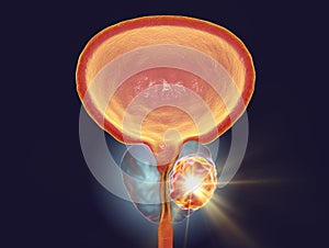 Conceptual image for prostate cancer treatment