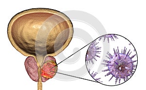 Conceptual image for viral ethiology of prostate cancer