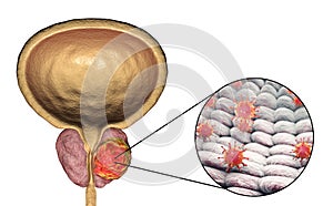 Conceptual image for viral ethiology of prostate cancer