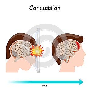 Concussion. brain  after head trauma