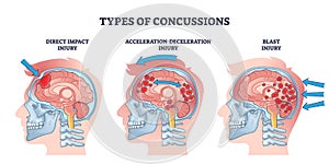 Concussion and head trauma or injury types from medical view outline diagram