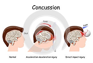 Concussion in sport. mild traumatic brain injury