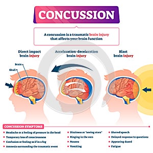 Concussion vector illustration. Labeled educational post head trauma scheme