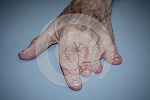 Congenital abnormality in left hand photo