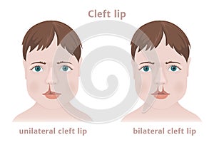 Congenital childhood pathology cleft lip.