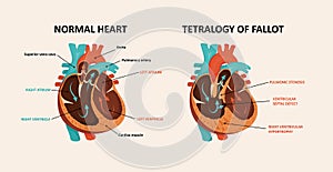 Congenital disease of the heart photo