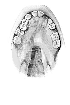 Congenital fissure of the soft palate in the old book D`Anatomie Chirurgicale, by B. Anger, 1869, Paris