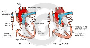 Congenital heart defect photo