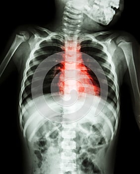 Congenital Heart Disease , Rheumatic Heart Disease ( X-ray body of child and red color on heart area )