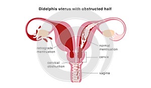 Congenital malformation of uterus isolating part of organ and causing retrograde menstruation as possible reason of