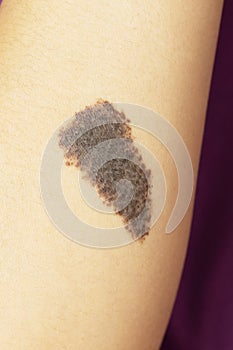 Congenital melanocytic naevi birthmark on a woman`s arm photo