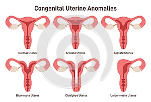 Congenital uterine anomalies set. Female reproductive system medical photo