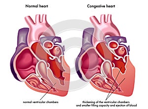 Congestive heart