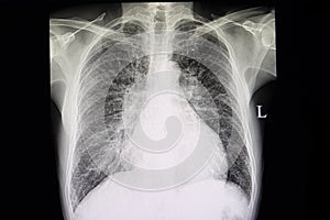 congestive heart failure