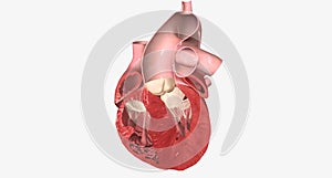 Congestive Heart Failure Left Sided Diastolic