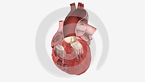 Congestive Heart Failure Left Sided Diastolic