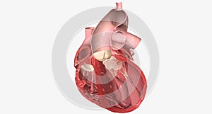 Congestive Heart Failure Left Sided Systolic