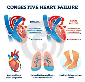 Congestive heart failure vector illustration. Labeled medical compare scheme