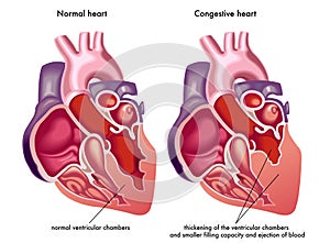 Congestive heart photo