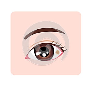 Conjunctival nevus vector illustration