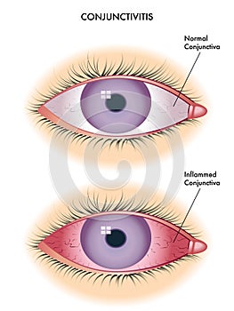 Conjunctivitis photo