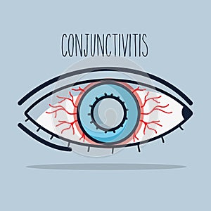 Conjunctivitis allergic inflammation of vision eye