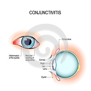 Conjunctivitis. External View and Vertical section of the human