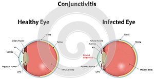 Conjunctivitis