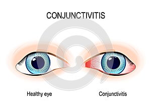 Conjunctivitis photo