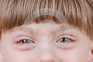 Conjunctivitis - ill allergic eyes