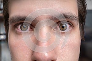 Conjunctivitis or irritation of sensitive eyes. Close-up view on red eyes of a man