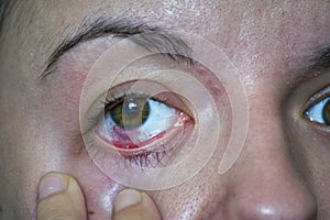 Conjunctivitis or pink eye