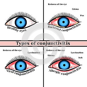 Conjunctivitis types. Inflammatory diseases of eyes photo