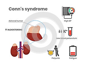 Conn`s syndrome causes and symptoms vector illustration.  Primary Aldosteronism scientific medical illustration