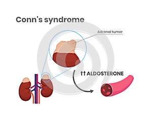 Conn`s syndrome pathophysiology. Primary aldosteronism scientific medical illustration