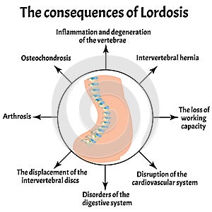 The consequences of lordosis. Spinal curvature, kyphosis, lordosis, scoliosis, arthrosis. Improper posture and stoop