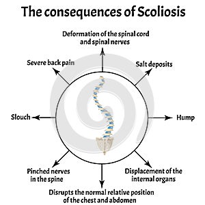 The consequences of scoliosis. Spinal curvature, kyphosis, lordosis of the neck, scoliosis, arthrosis. Improper posture