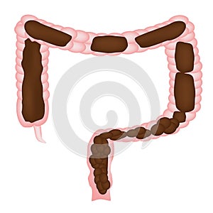 Constipation. Feces in colon. Infographics. Vector illustration on isolated background.