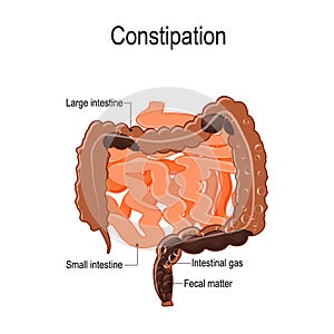 Constipation. Vector illustration