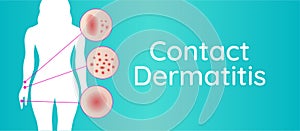 Contact Dermatitis Background Illustration with Woman and Irritation Closeups