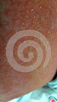 Contact dermatitis with secondary streptococcal cellulitis and lymphangitis photo
