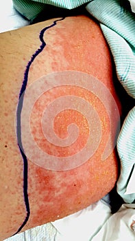 Contact dermatitis with secondary streptococcal cellulitis and lymphangitis photo