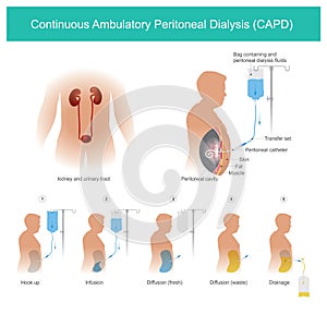 Continuous Ambulatory Peritoneal Dialysis CAPD